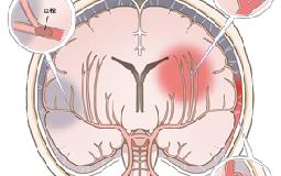 ＜こうえんじ通信＞突然のサイン：顔の左右が非対称になる、手が上がらない、言葉がしゃべれない　